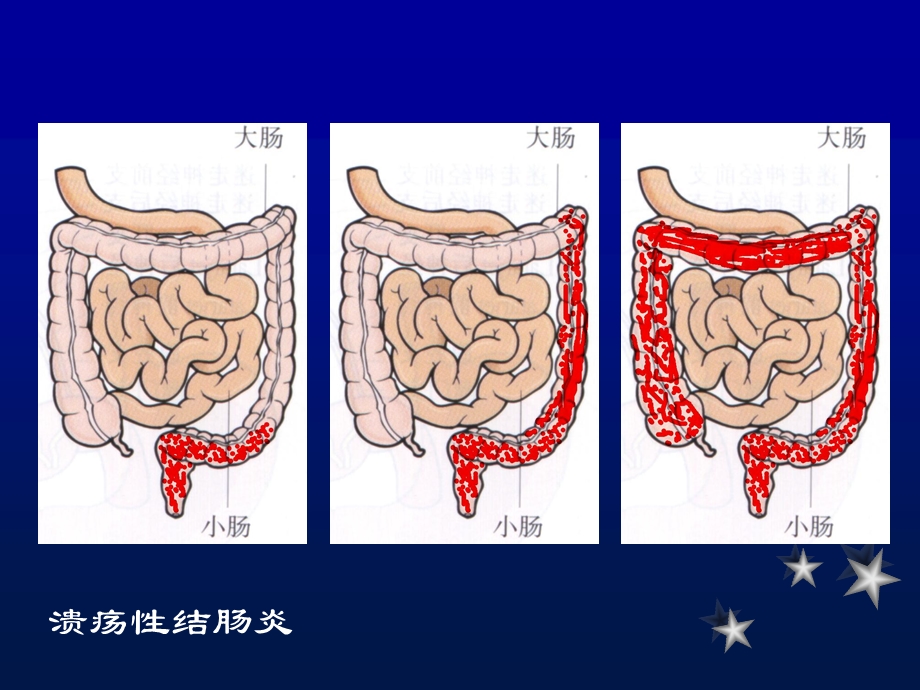 炎症性肠炎课件.ppt_第3页