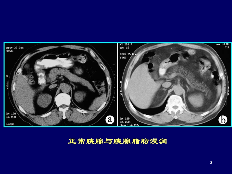 胰腺常见病变的CT诊断课件.ppt_第3页