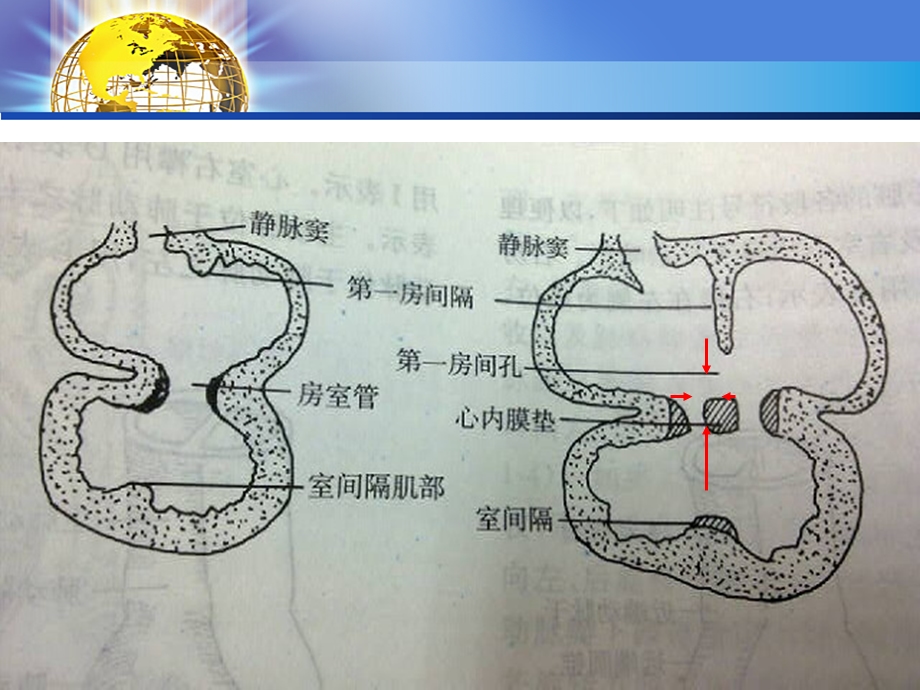 房室间隔缺损课件.ppt_第3页