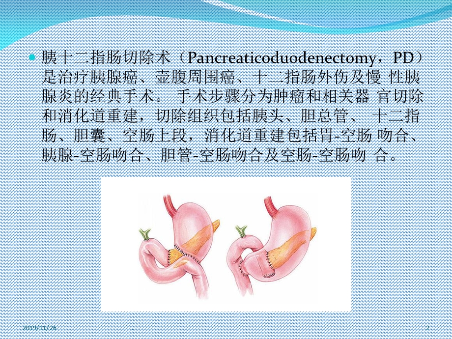 胰十二指肠术后并发症课件.ppt_第2页