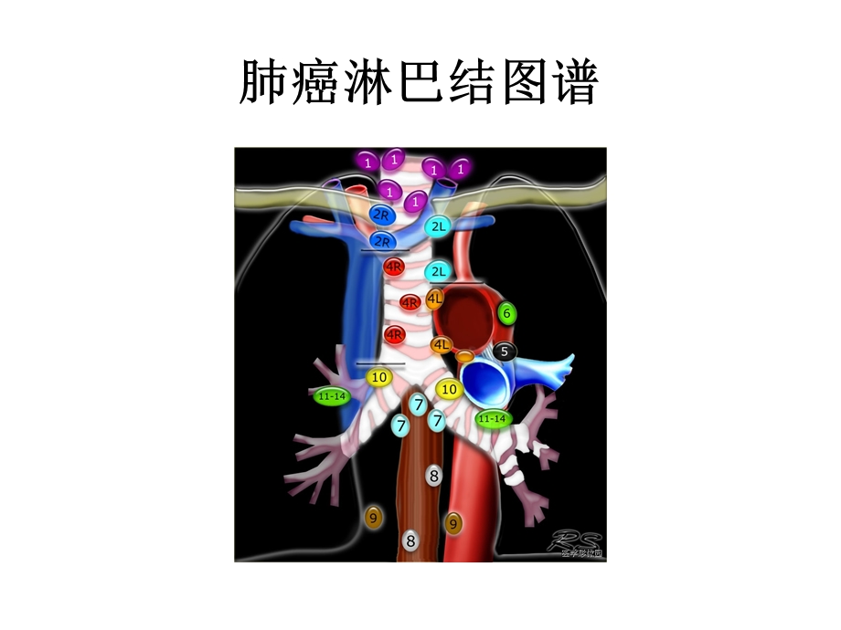 肺癌淋巴结图谱课件.ppt_第2页