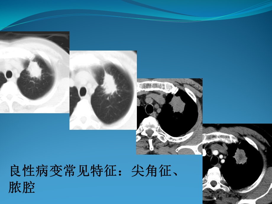 胸腔镜下肺部手术的护理配合课件.pptx_第3页