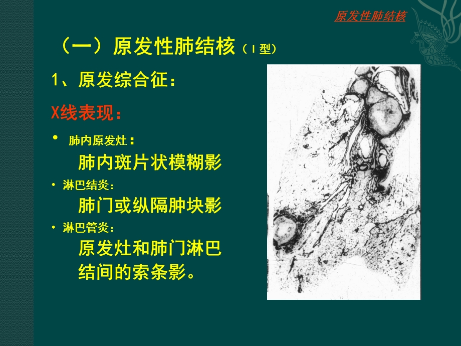 肺结核 肺肿瘤课件.ppt_第3页