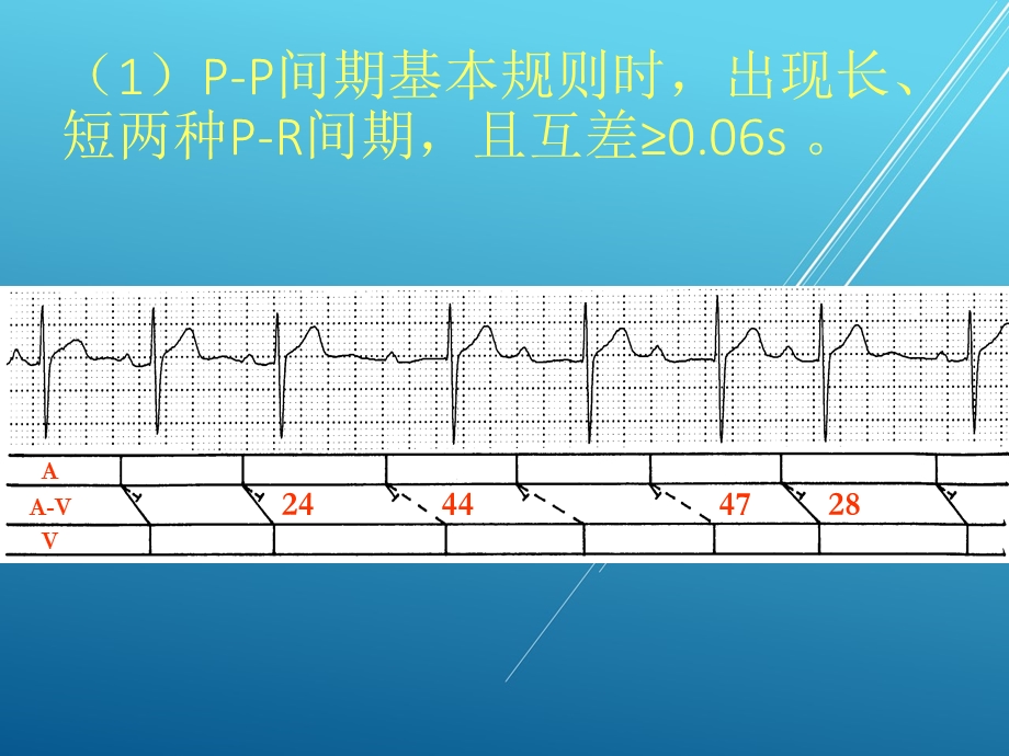双径路、多径路传导的心电图表现课件.pptx_第3页