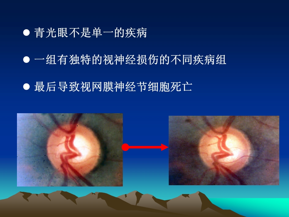 青光眼的合理用药课件.ppt_第3页