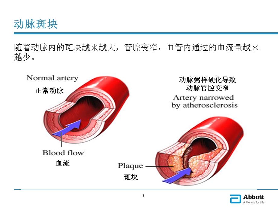 雅培心脏标志物课件.ppt_第3页