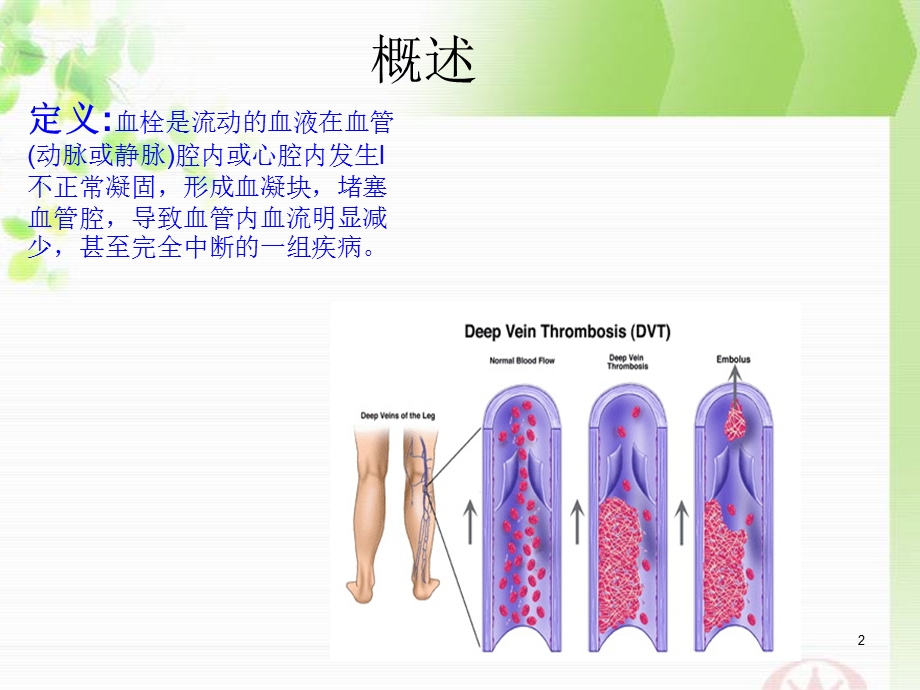 双下肢深静脉血栓形成课件.ppt_第2页