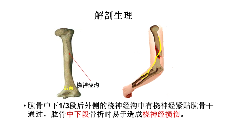 常见四肢骨折护理课件.ppt_第3页