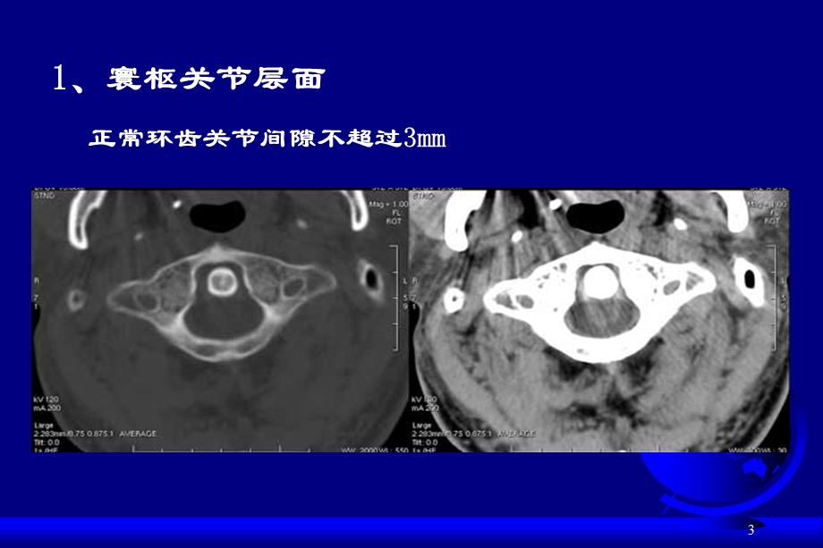 颈椎和颈髓病变影像学诊断课件.ppt_第3页