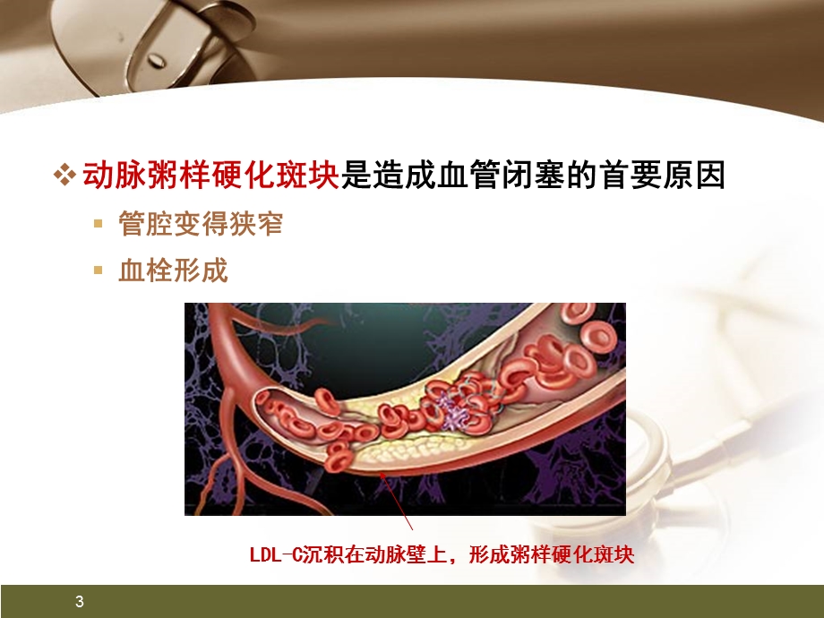 心肌梗死健康宣教幻灯片精品课件.pptx_第3页