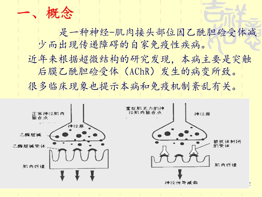 重症肌无力的护理课件 课件.ppt_第2页