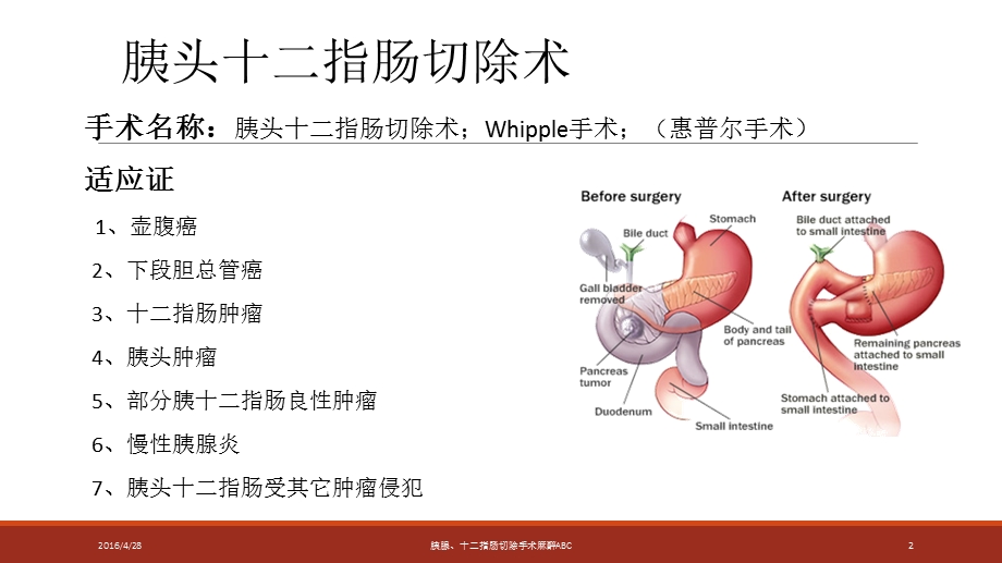 胰腺指肠手术麻醉ABC培训ppt课件.ppt_第2页