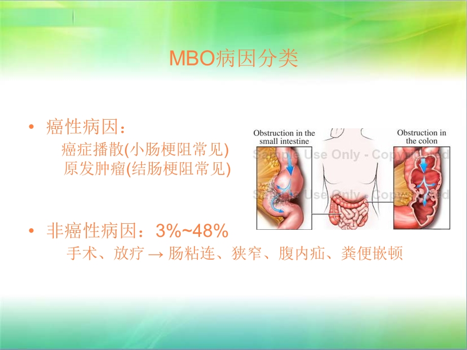 恶性肠梗阻课件.ppt_第3页