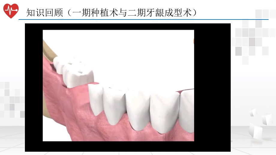 牙科种植术《种植印模及模型工艺》含视频课件.pptx_第3页