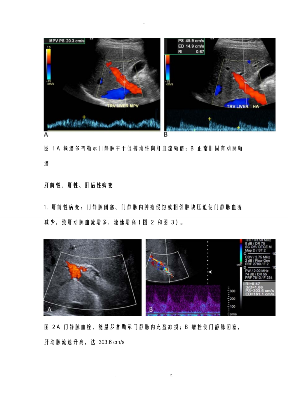 医考掌握肝动脉血流有助于诊断潜在性肝病.docx_第2页