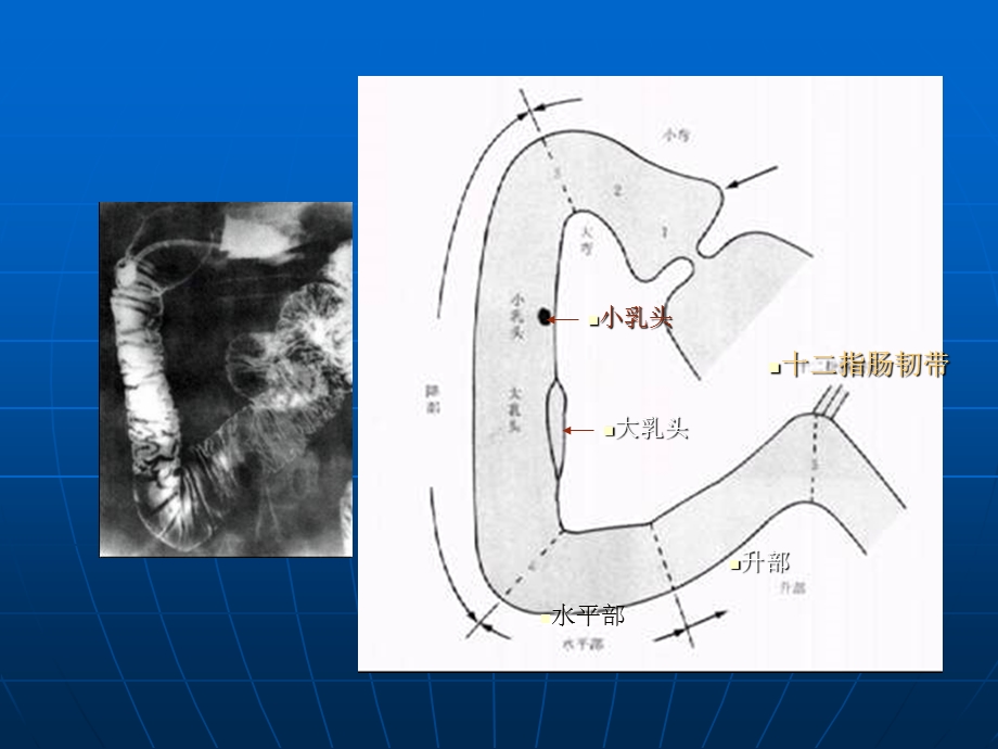 十二指肠疾病.ppt_第3页