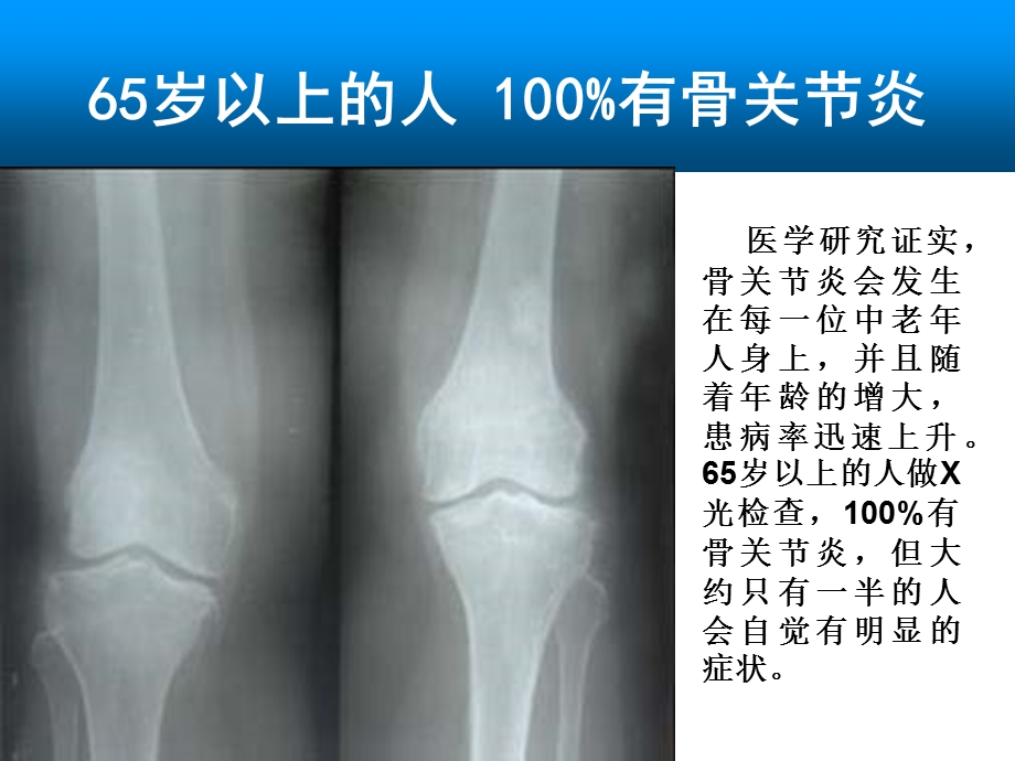 氨糖与骨关节病专家会销课件2.ppt_第3页