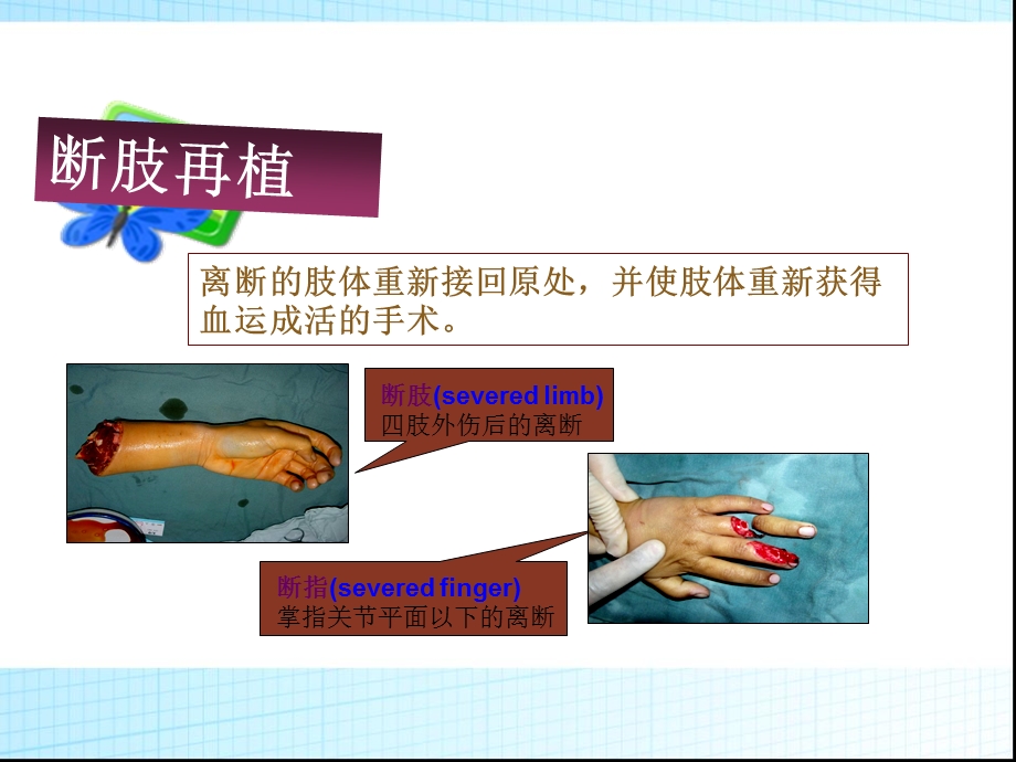 断肢再植护理查房课件.ppt_第1页