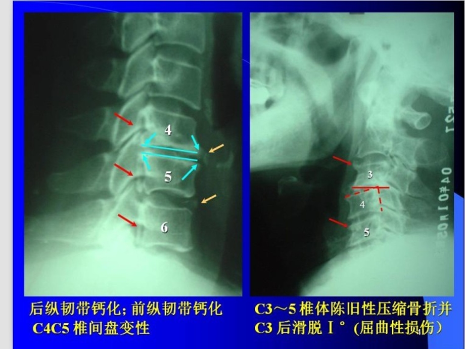 颈椎阅片.ppt_第2页