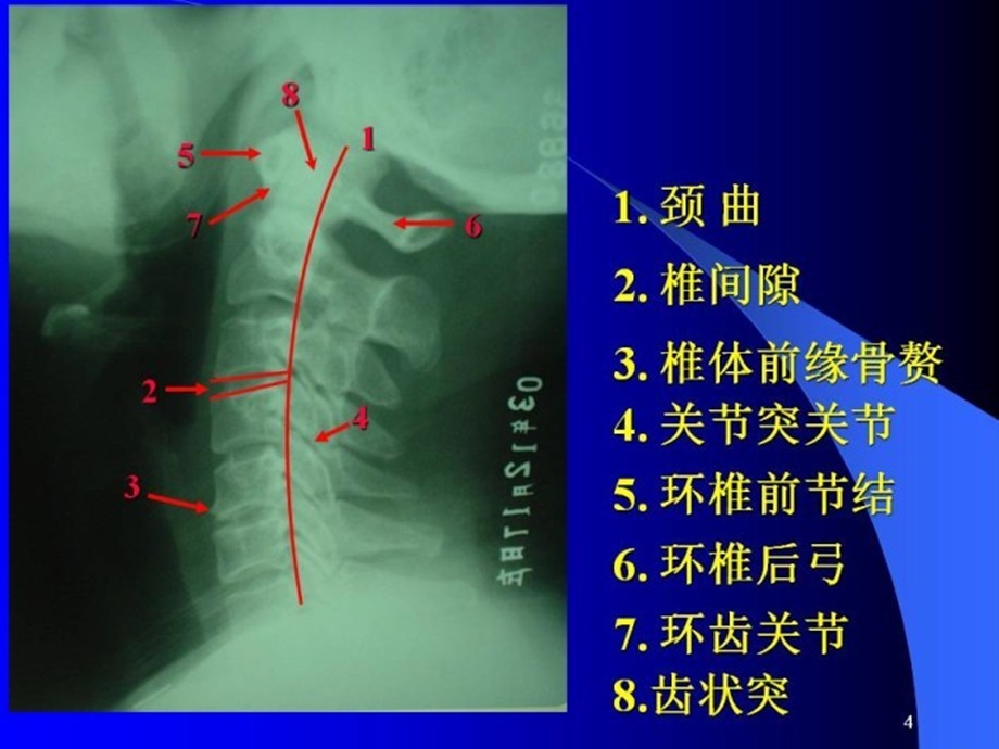 颈椎阅片.ppt_第3页