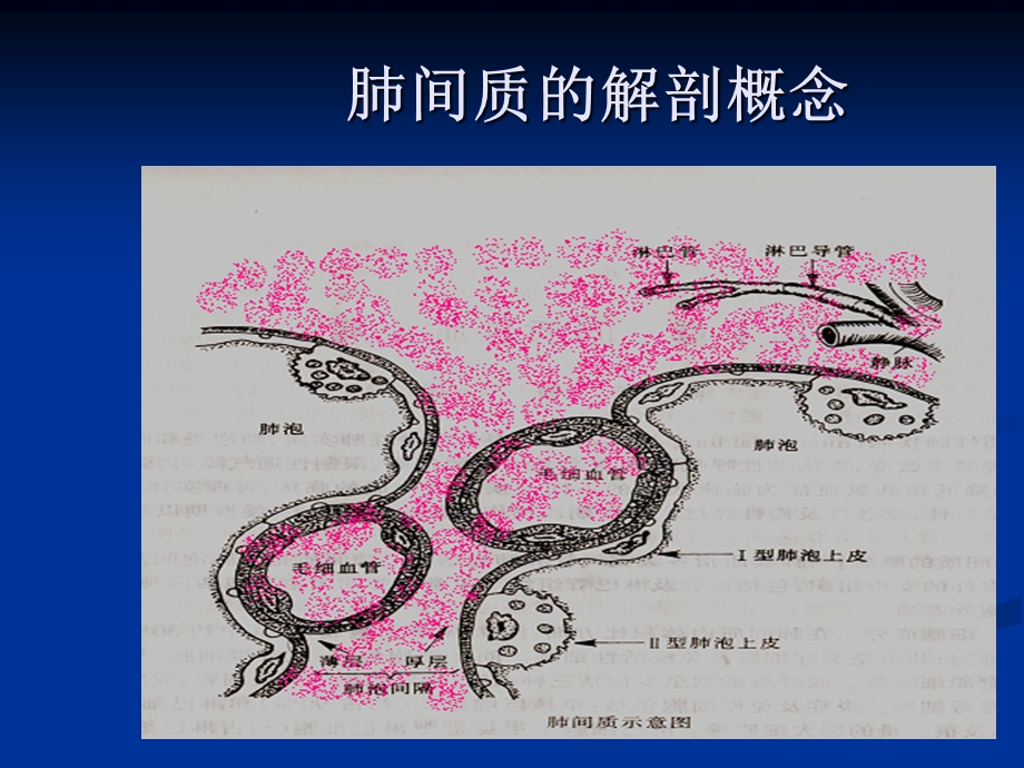 4特发性肺纤维化.ppt_第3页