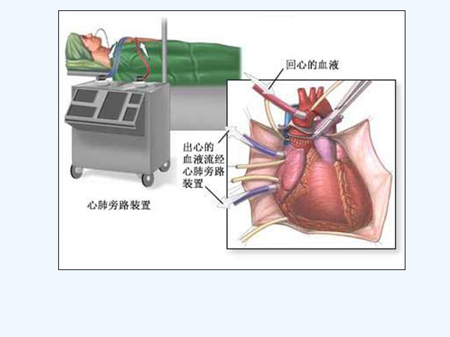 体外循环心脏术后并发症观察和护理课件.ppt_第3页