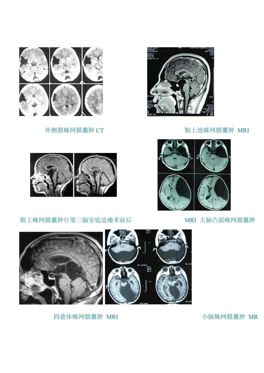 蛛网膜囊肿的定义.doc_第3页