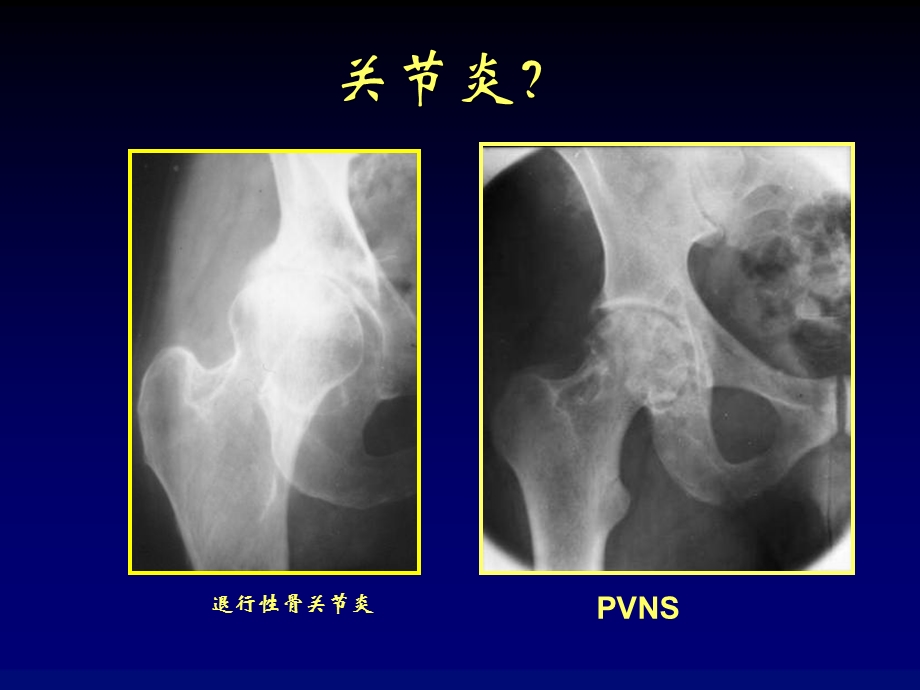 关节炎的影像学评价课件PPT文档.ppt_第3页