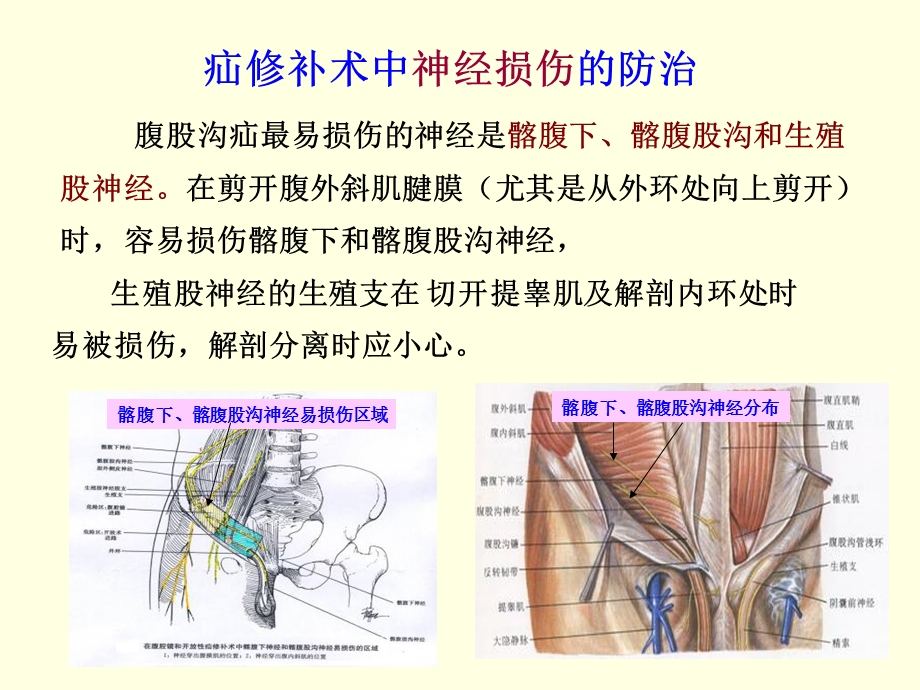 无张力疝修补术后损伤及并发症文档资料.ppt_第3页