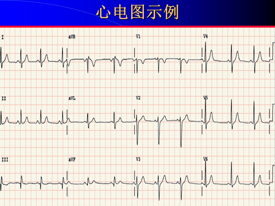 正常心电图PPT文档.ppt_第3页