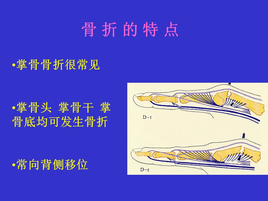 最新：掌骨骨折内固定文档资料.ppt_第2页