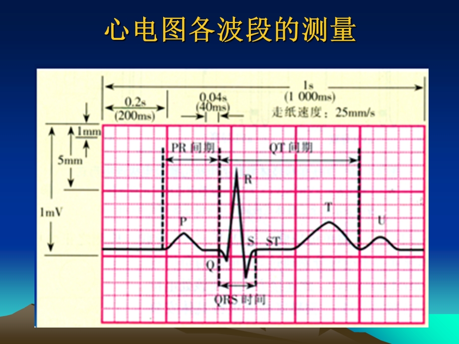 最新：②正常心电图及测量文档资料.ppt_第3页