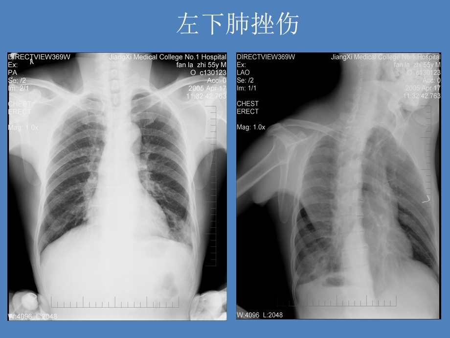 最新：南昌大学影像精品课程之胸部外伤之二文档资料.ppt_第1页