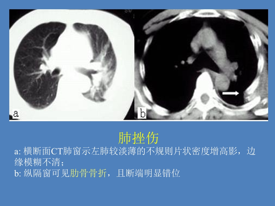 最新：南昌大学影像精品课程之胸部外伤之二文档资料.ppt_第2页