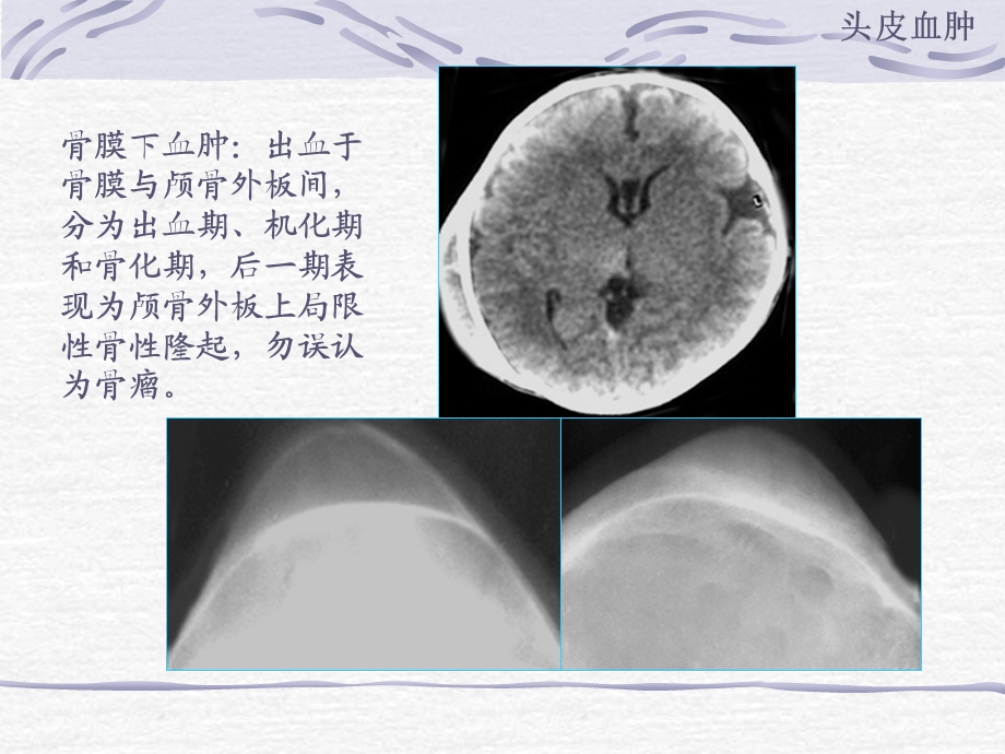 最新颅脑外伤的CT表现PPT文档.ppt_第3页