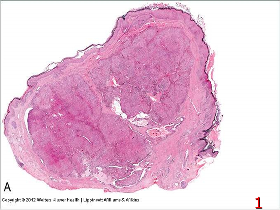 最新：伴肌上皮分化皮肤附件肿瘤文档资料.ppt_第1页