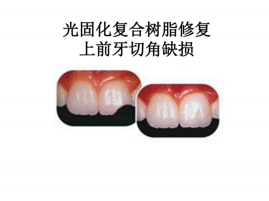 光固化复合树脂修复上切牙切角缺损图文.ppt.ppt_第1页