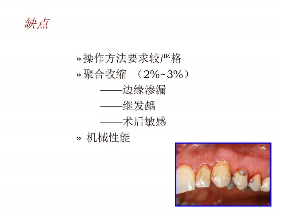 光固化复合树脂修复上切牙切角缺损图文.ppt.ppt_第3页