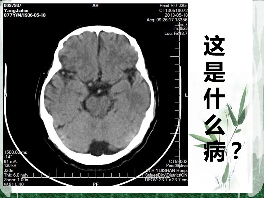 蛛网膜囊肿2.ppt_第2页