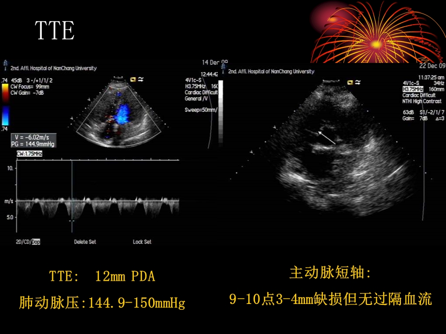 合并重度肺动脉高压动脉导管未闭介入治疗.ppt_第3页