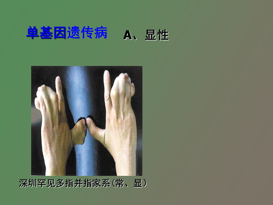 人类遗传病文科.ppt_第3页