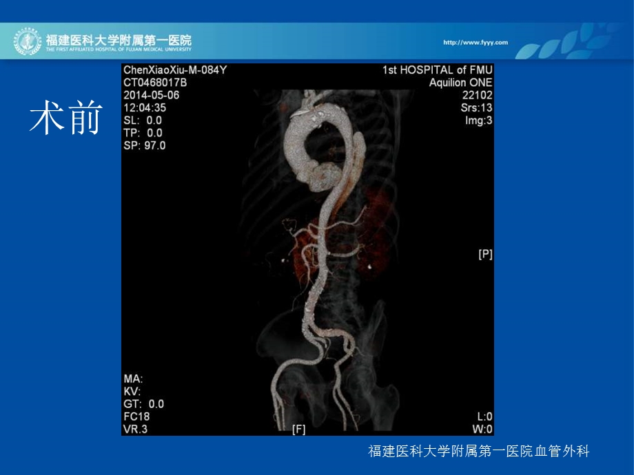 主动脉夹层的腔内治疗经验.ppt_第2页