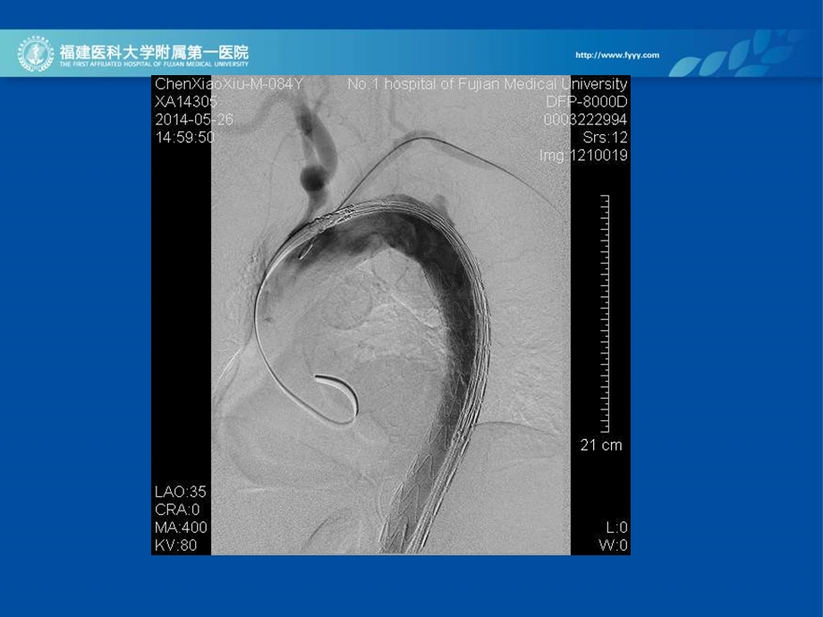 主动脉夹层的腔内治疗经验.ppt_第3页