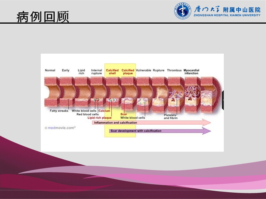 中心静脉置管与血栓形成.ppt_第3页