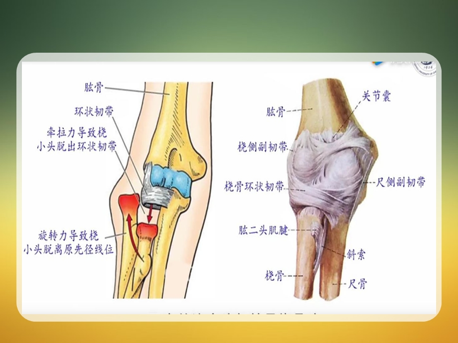 小儿桡骨小头半脱位.ppt_第3页