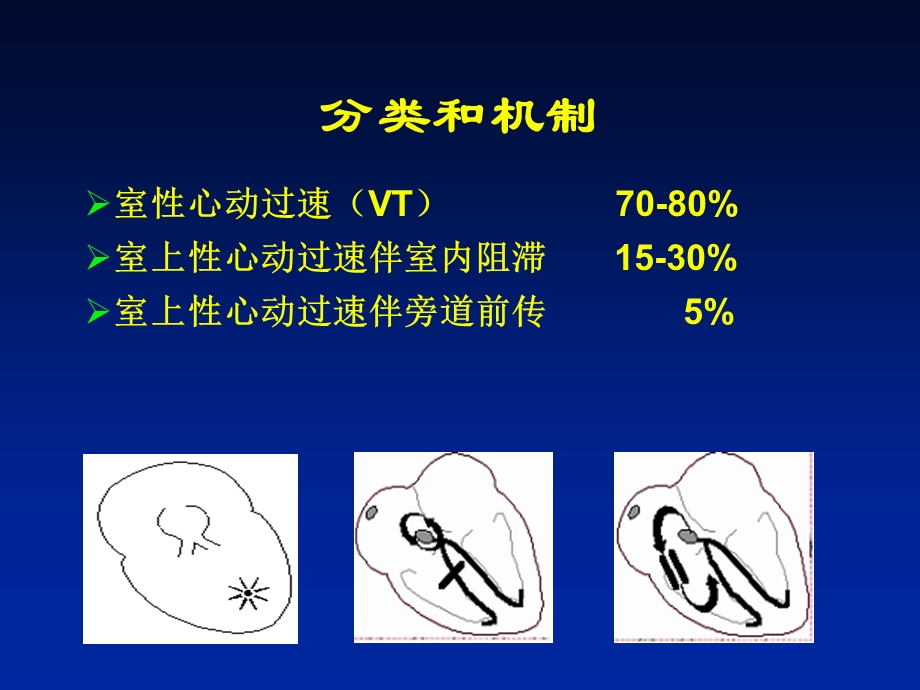 宽QRS心动过速的诊断和处理.ppt_第3页