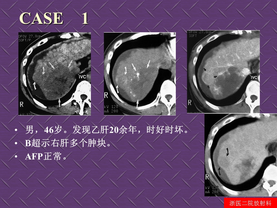 腹部病变影像诊断与鉴别(杨光钊).ppt_第2页