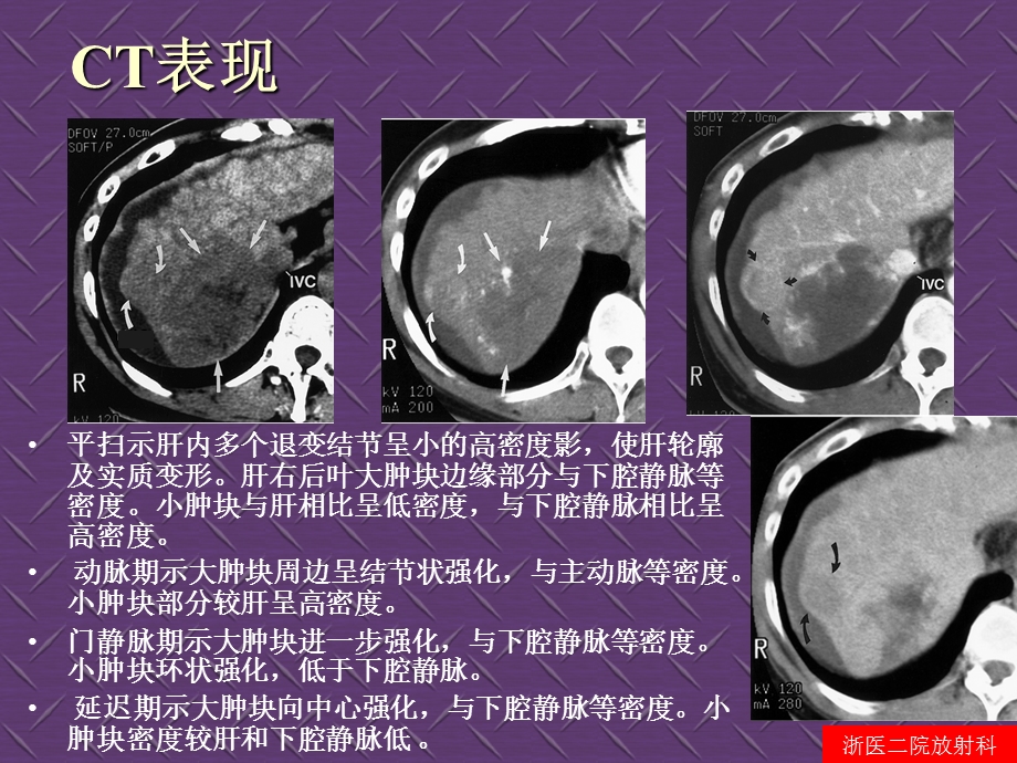 腹部病变影像诊断与鉴别(杨光钊).ppt_第3页