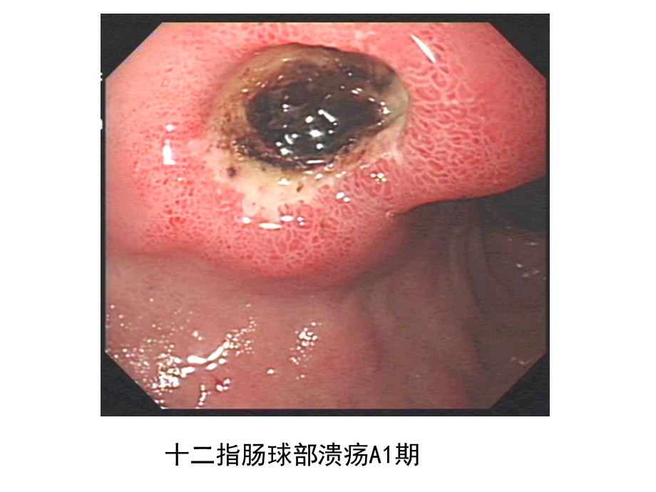 消化性溃疡图片.ppt_第1页