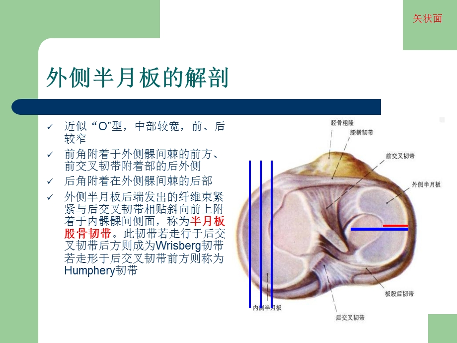 膝关节半月板损伤MRI诊断(ppt).ppt_第3页